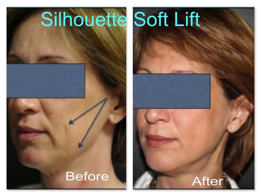 silhouette-soft-thread-lift